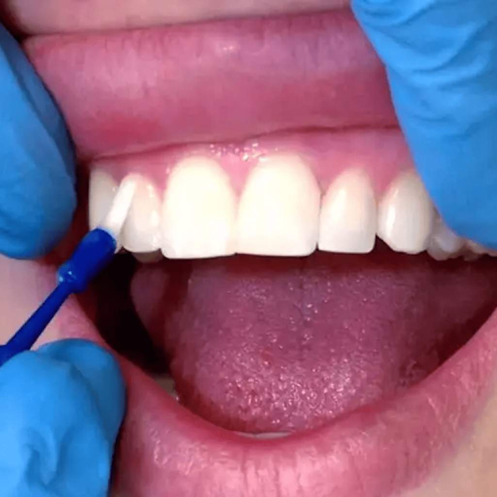 A Med - Postupak fluorizacije