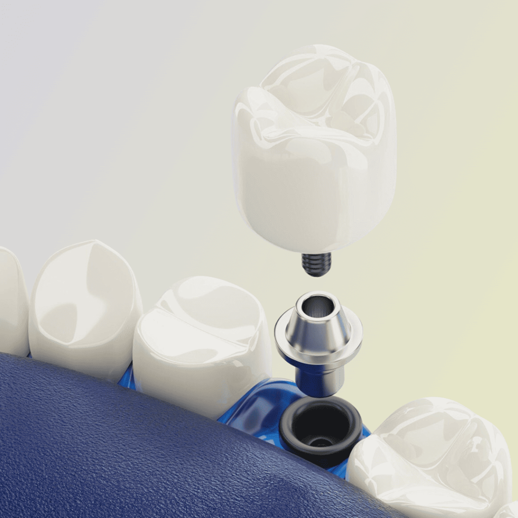 Prikaz ugradnje zubnog implantata – implant, abatment i krunica između prirodnih zuba