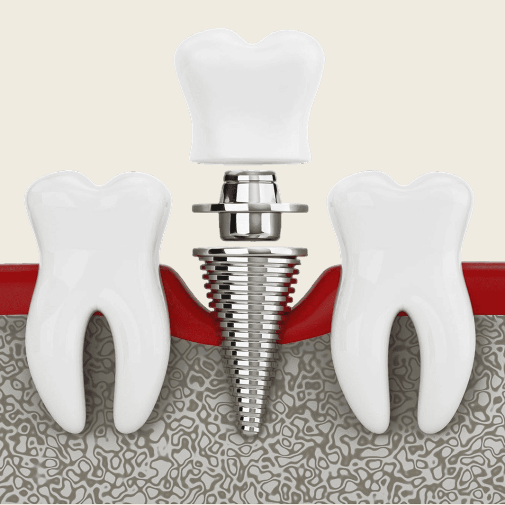 A Med - Ugradnja implantata Beograd