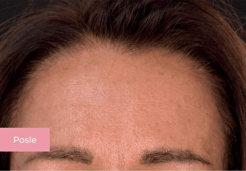 Botox posle