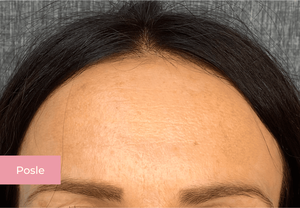 Botox posle