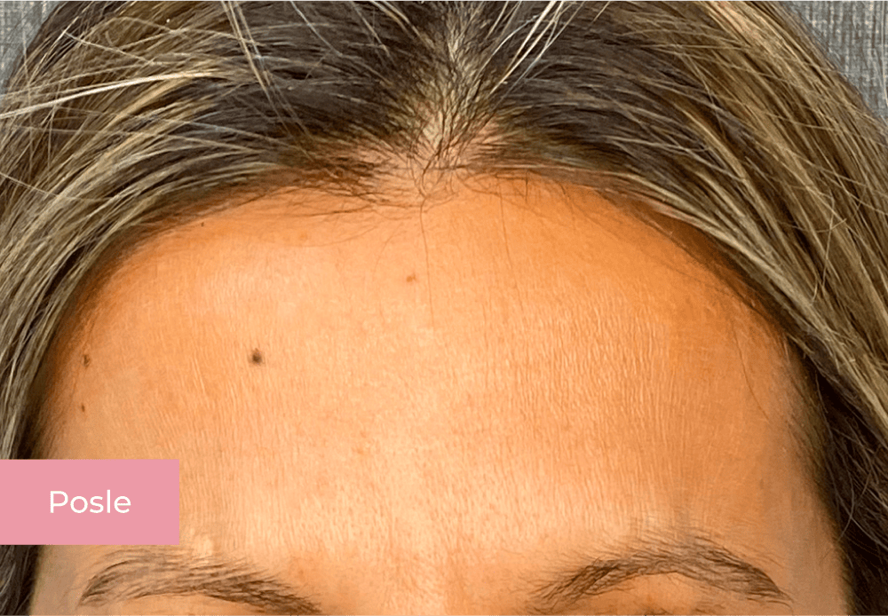 Botox lica posle