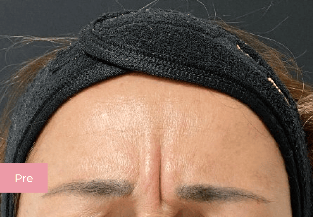 Botox pre