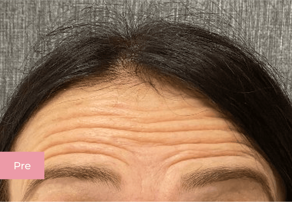 Botox pre