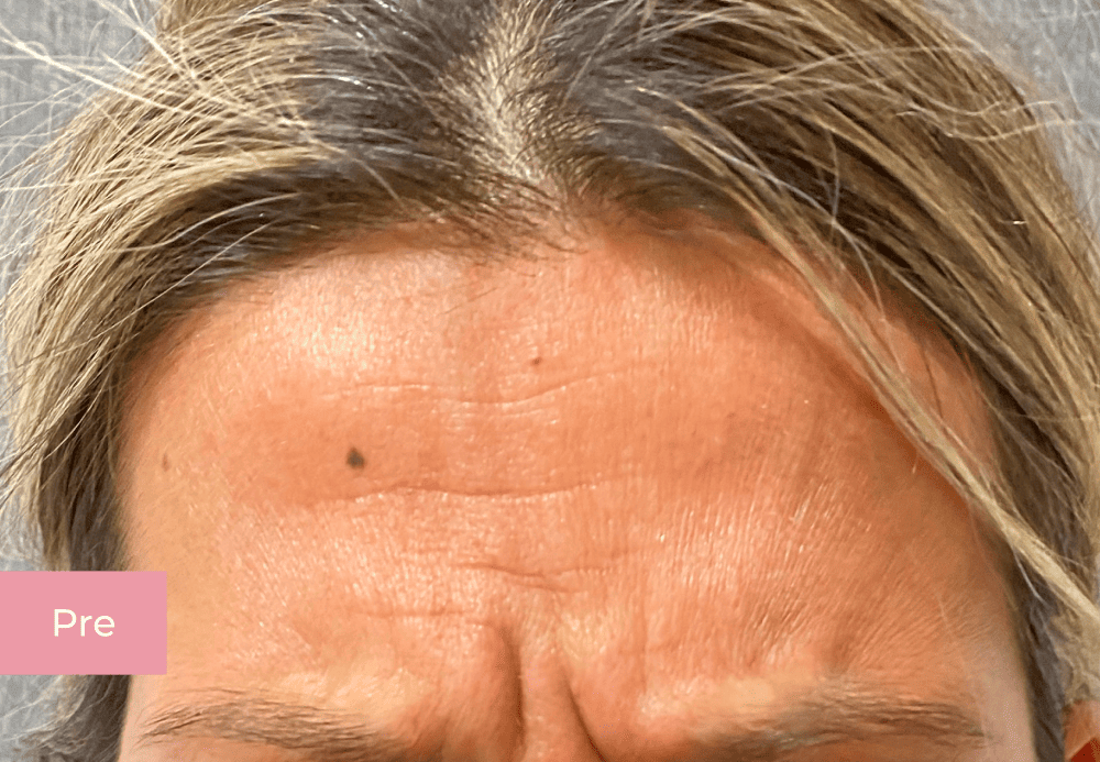Botox lica pre