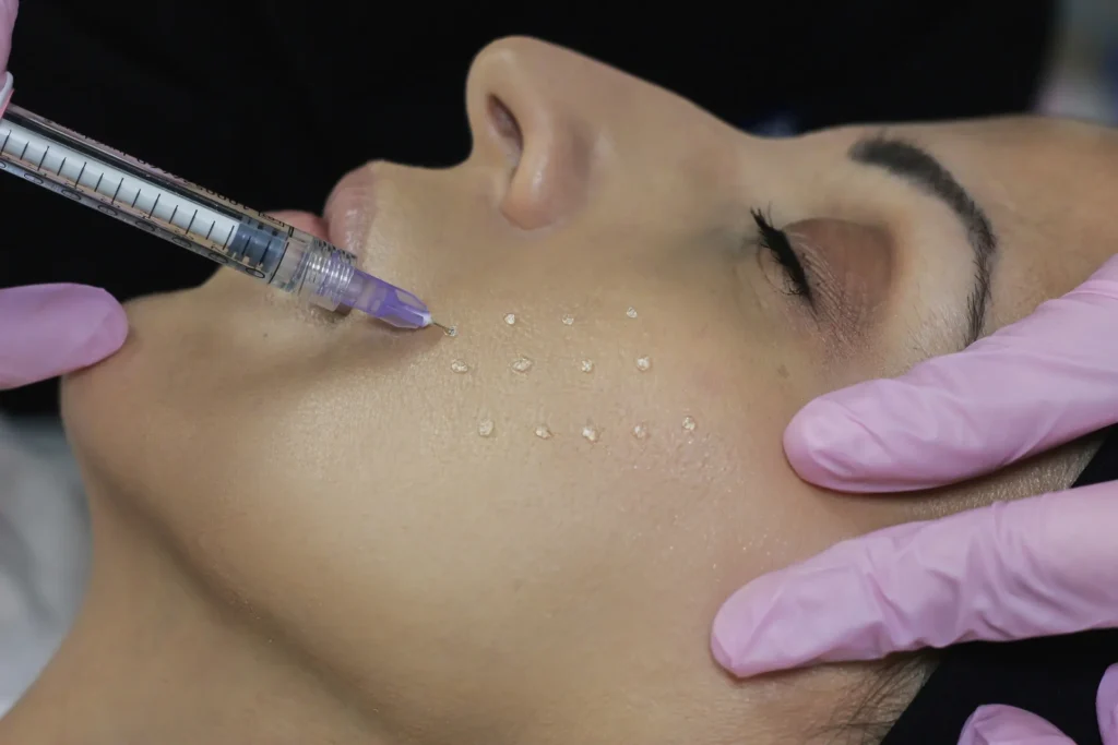 Estetski tretman hijaluronskim filerima, žena tokom aplikacije filera u lice, prikaz modernog anti-aging postupka