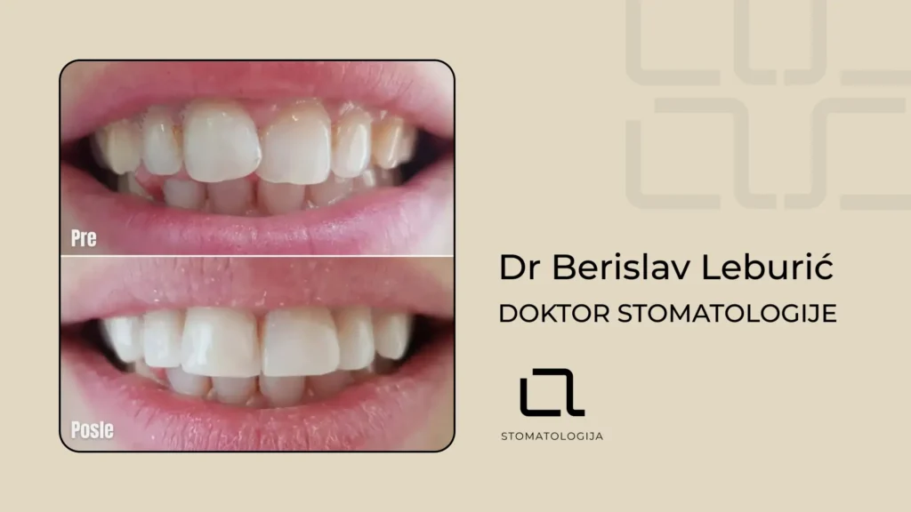 Slika koja pokazuje rezulat pre i posle Dr. Berislava Leburića kompozitne fasete