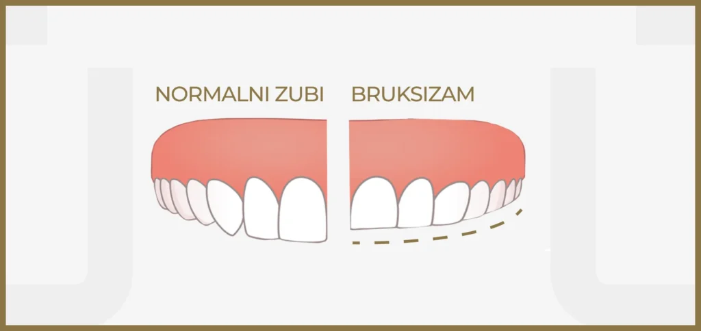 Prikaz kontrasta između netaknutih, pravilnih zuba i zuba koji pokazuju znakove bruksizma – abradedirane grizne površine i promjene u strukturi uzrokovane stiskanjem i škripanjem.