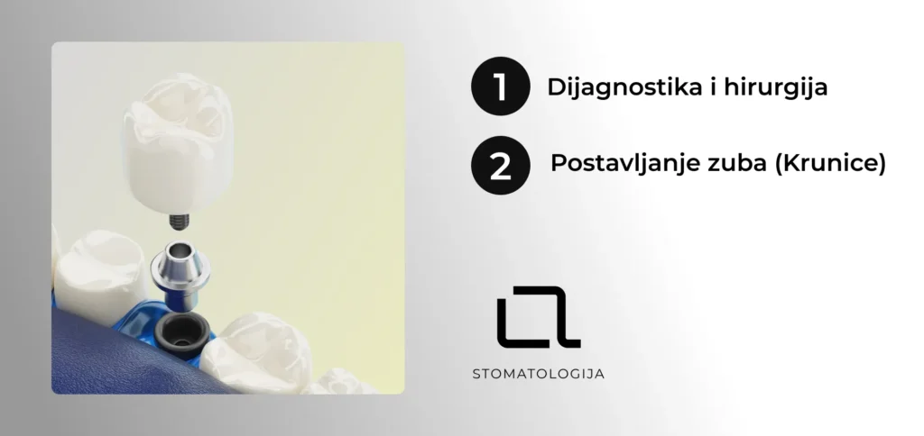 Dijagram hirurškog postupka ugradnje zubnog implantata, koji prikazuje postavljanje titanijumskog šrafa (implantata) direktno u čeljusnu kost.