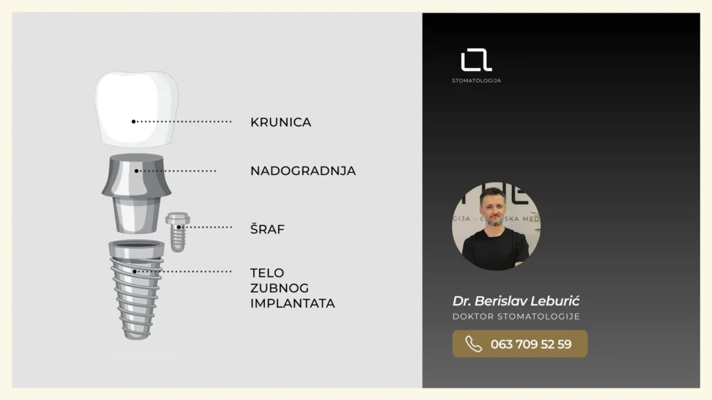 Ilustracija zubnog implantata koji se sastoji od titanijumskog šrafa u kosti, abatmenta i keramičke krunice.