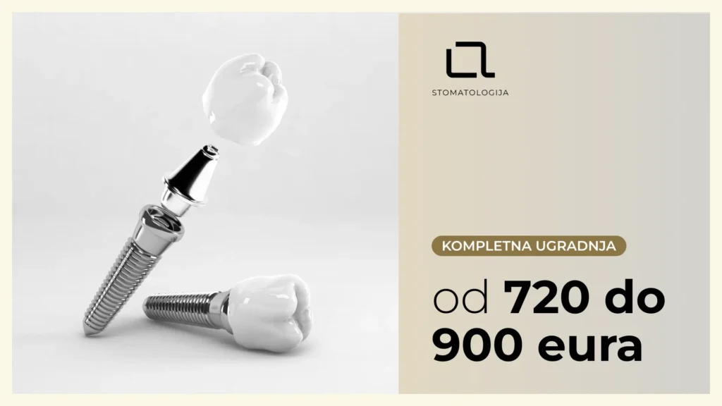Cena kompletne ugradnje zubnog implantata u A Med ordinaciji – od 720 do 900 evra