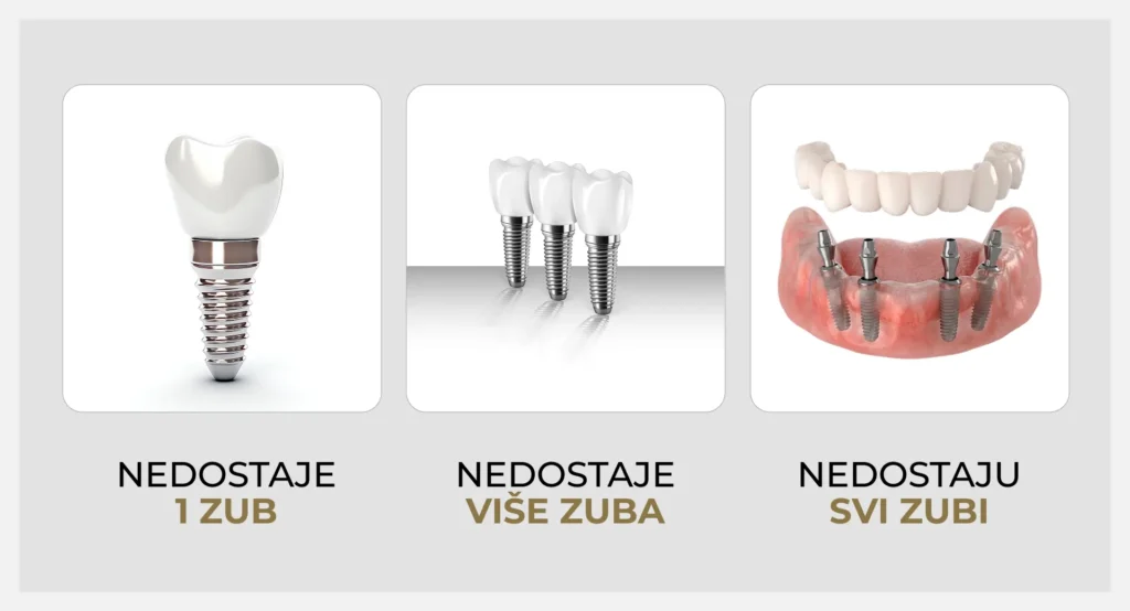 Tri situacije za ugradnju implantata – nedostaje jedan zub, više zuba ili svi zubi
