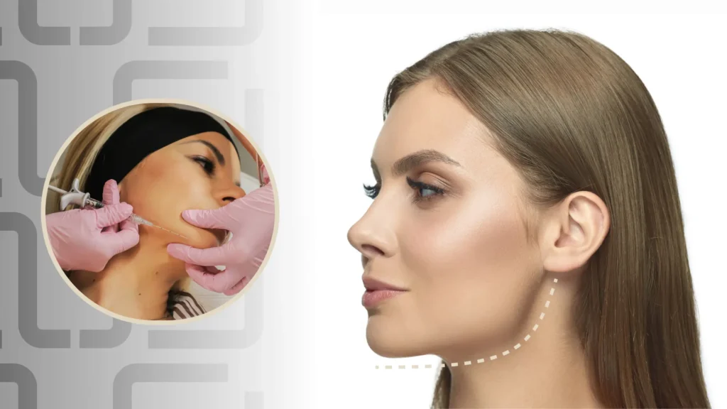 Jawline tretman sa hijaluronskim filerima