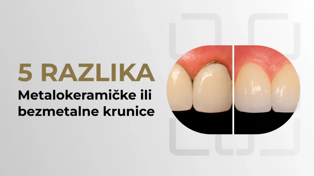 metalokeramičke i bezmetalne krunice – prirodan osmeh