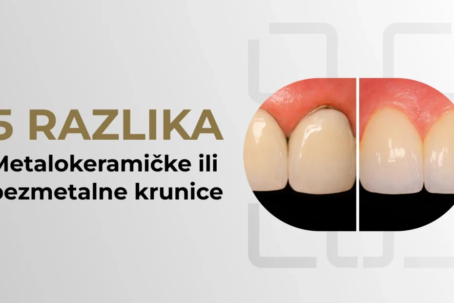 metalokeramičke i bezmetalne krunice – prirodan osmeh