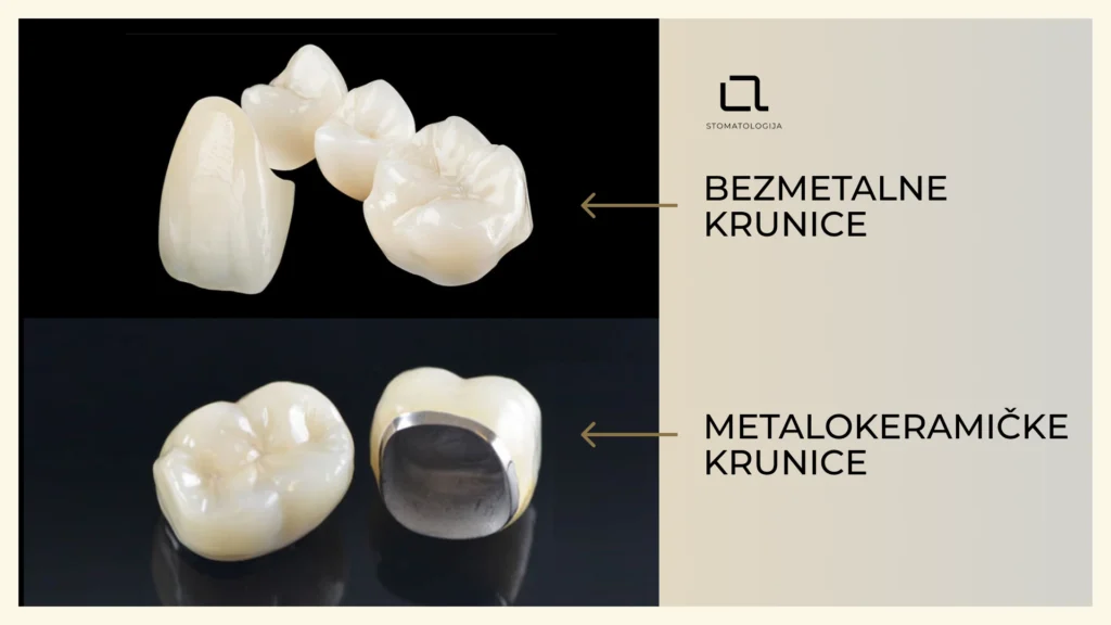 metalokeramička krunica i bezmetalna krunica – struktura