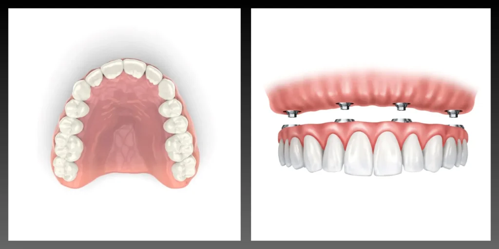Poređenje klasične akrilatne proteze sa nepčanom pločom i moderne proteze bez nepca.