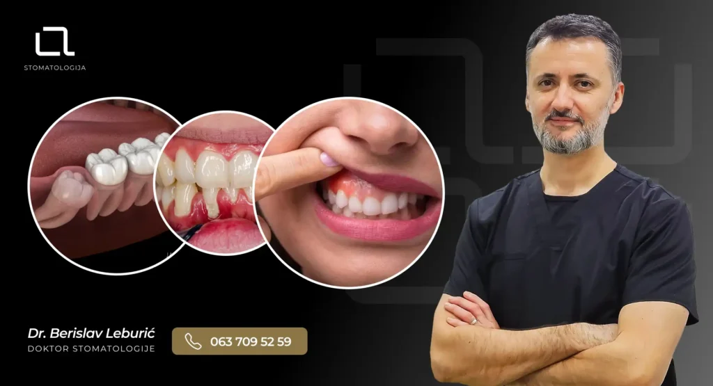Ilustracija najčešćih uzroka bola u desnima: gingivitis, parodontopatija i fistula