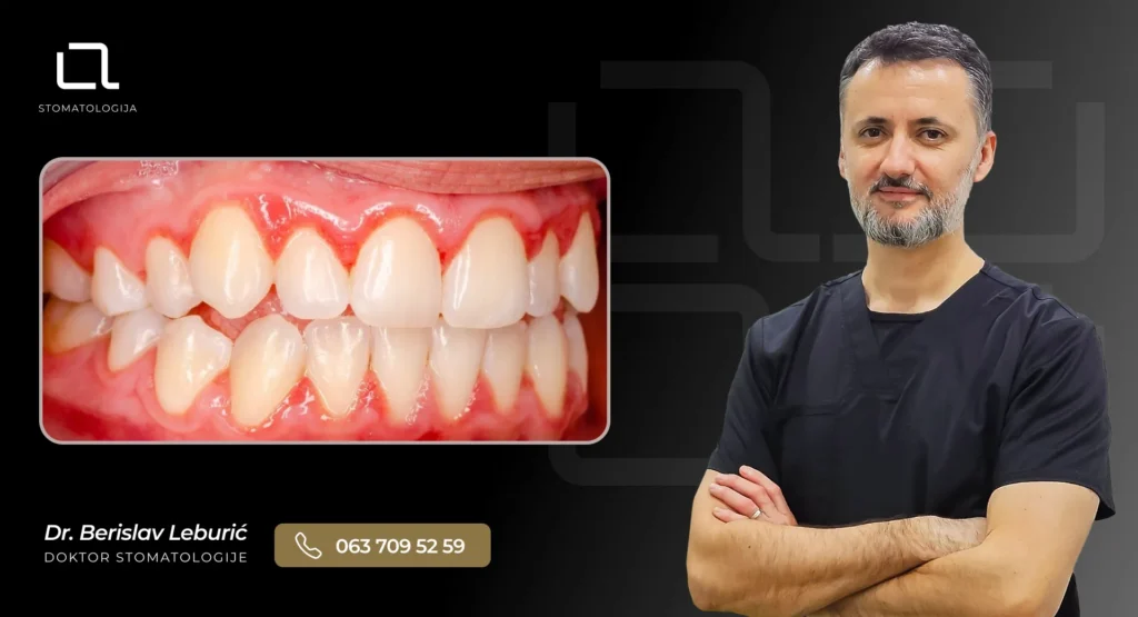 Primer upaljenih desni kod trudničkog gingivitisa