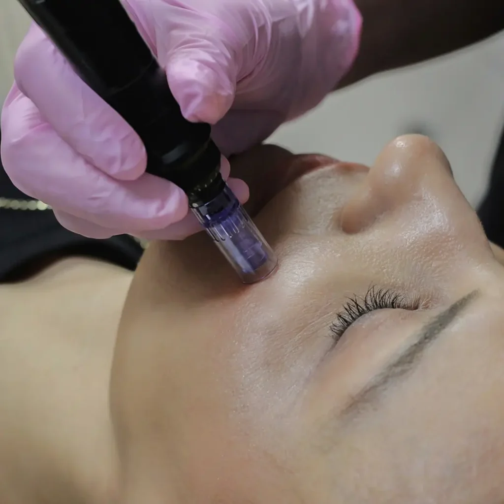 Dermapen uređaj i Biosome egzozomi pripremljeni za kombinovani tretman lica u A Med Beograd